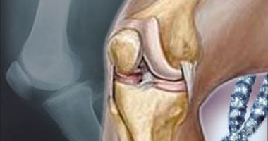 خشونة الركبة من أكثر الإصابات التى يتعرض لها الرياضيون