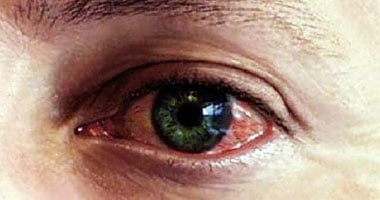 الاستعانة بالوخز بالإبر يسهم فى علاج نحو 17% من حالات كسل العين